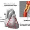 Ateroscleroza coronariana si cardiopatiile ischemice