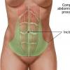 Chirurgia abdomenului cu pliuri (abdominoplastia)