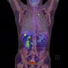Examinarea PET/CT - O noua speranta in investigatia bolilor oncologice