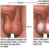 Varicocelul - dilatatia venelor spermatice