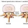 Indicatiile opiozilor in tratamentul stenozei spinale