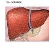 Cauzele si complicatiile cirozei hepatice