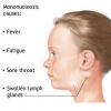 Mononucleoza sau boala sarutului