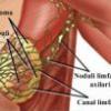 Stadiile cancerului mamar 