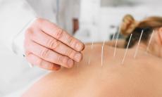 Beneficiile acupuncturii