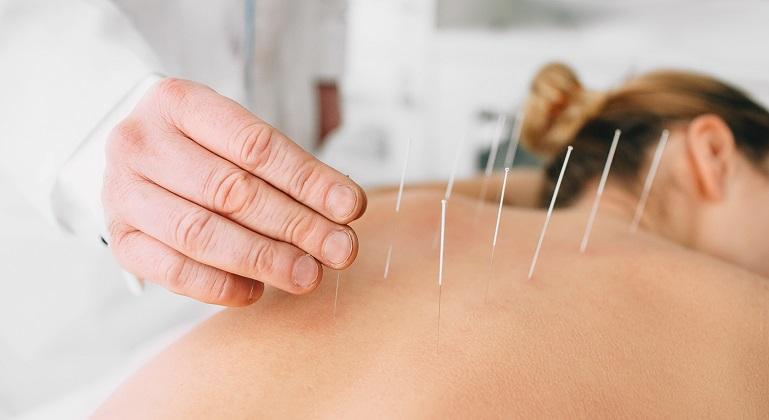 Beneficiile acupuncturii