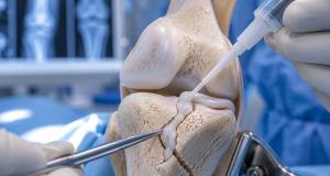 Oasele fracturate ar putea fi reparate cu un nou adeziv medical