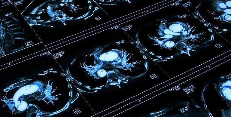 Factori de risc pentru anevrismul aortic toracic