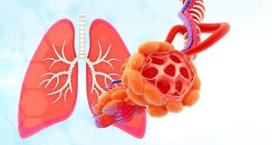 Explorarea bolilor rare pulmonare: prezentare, diagnostic si tratament