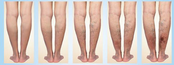 Complicatiile insuficientei venoase superficiale