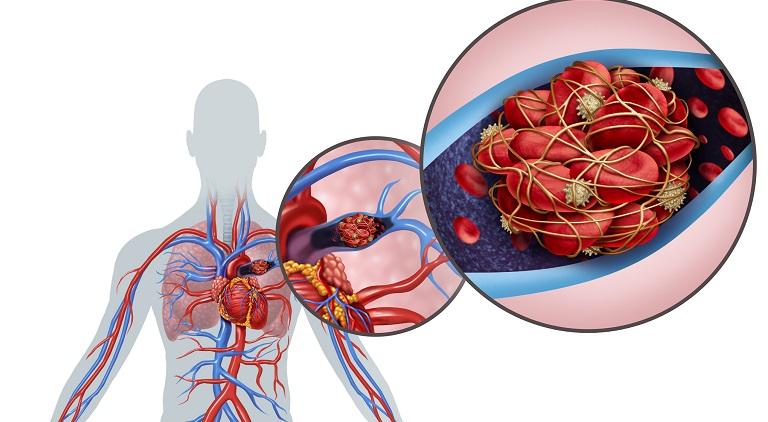 Trombembolismul pulmonar - factori de risc si masuri de prevenire