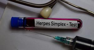 Infectia cu herpes simplex: cauze, simptome, tratament