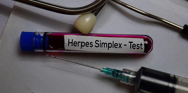 Infectia cu herpes simplex: cauze, simptome, tratament