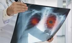 Lobectomia pulmonara - optiune medicala pentru afectiunile pulmonare complexe