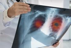 Lobectomia pulmonara - optiune medicala pentru afectiunile pulmonare complexe
