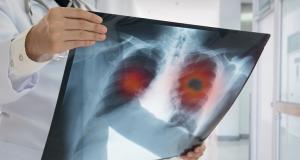 Lobectomia pulmonara - optiune medicala pentru afectiunile pulmonare complexe