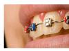Ortodontia - indreptarea si corectarea pozitiei dintilor