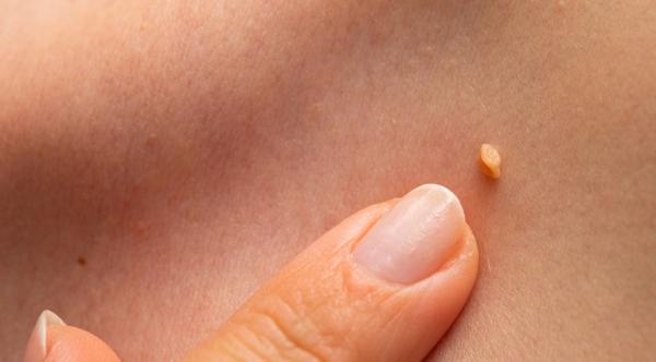 Papiloamele cutanate - ce sunt, de ce apar si cum sunt tratate 