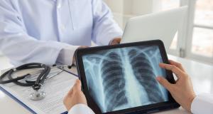 Screeningul pulmonar - instrument de diagnostic precoce al cancerului 