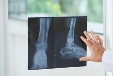 Sindromul Müller-Weiss, o boala degenerativa rara a piciorului