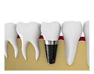 Totul despre implantul dentar