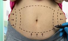 Abdominoplastia, solutia rapida pentru un abdomen atractiv