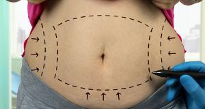 Abdominoplastia, solutia rapida pentru un abdomen atractiv