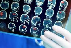 Depistarea primelor semne ale accidentului vascular cerebral