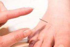 Ameliorarea durerilor artritice prin acupunctura 