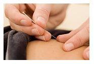 Acupunctura si beneficiile sale