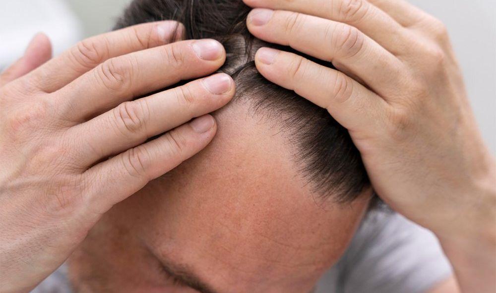 Alopecia de tractiune - cand poate fi necesar implantul de par?