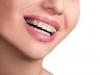 Semnele care arata ca ai nevoie de un aparat dentar