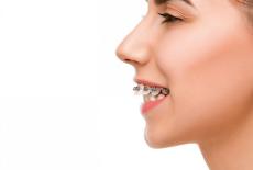 Dantura de revista: scurt ghid privind optiunile de tratament ortodontic