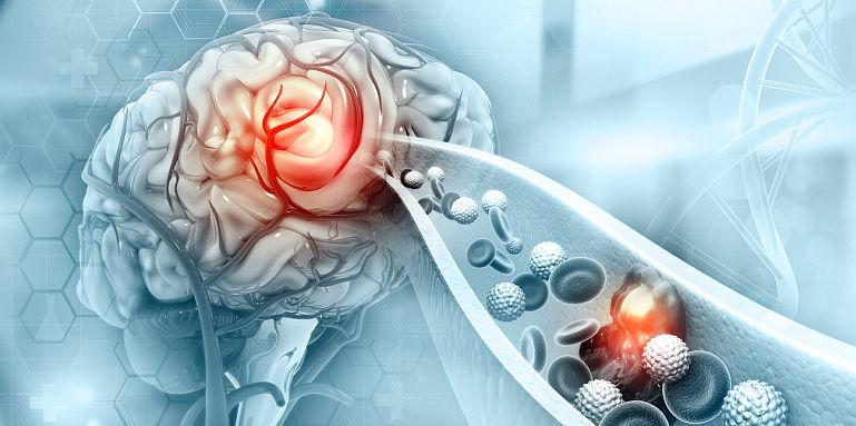 Cum putem recunoaste un accident vascular cerebral ?