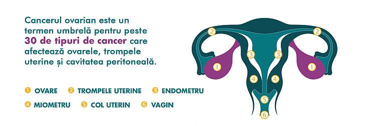  Cancerul ovarian poate avea o supravietuire de pana la 94%. Care sunt simptomele care ar trebui sa le trimita pe femei la doctor?