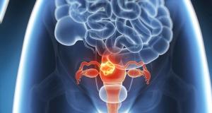 Teste de diagnostic pentru cancerul de col uterin