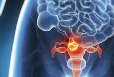 Cancerul de col uterin - simptome, cauze, tratament