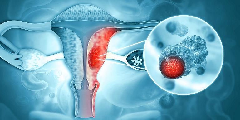 Cancerul ovarian, neoplasmul cu cea mai mica rata de supravietuire in randul femeilor