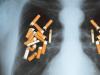 Cancerul pulmonar - cum poti recunoaste din timp simptomele?