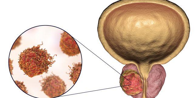 Simptomele precoce ale cancerului de prostata