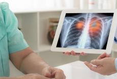 Cancerul pulmonar poate fi vindecat, daca il depistezi la timp