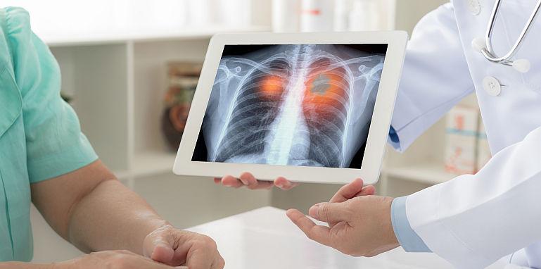 Care sunt simptomele precoce ale cancerului pulmonar?