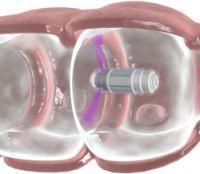 Capsula de investigare a intestinelor ii poate ajuta pe medici sa depisteze cancerul de colon