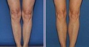 Implantul in gambe, noul trend in materie de chirurgie estetica