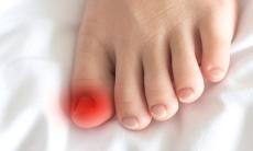 Ce se intampla daca ignori micoza unghiei? Riscuri ascunse pentru sanatate