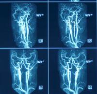 Ecografia Doppler vasculara 