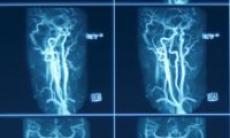 Ecografia Doppler vasculara 