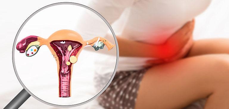 Endometrioza la adolescente