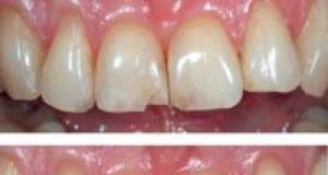 Fatetele dentare – PRO sau CONTRA