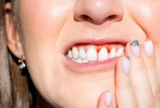 Gingivita - afectiunea gingiilor care poate duce la pierderea dintilor